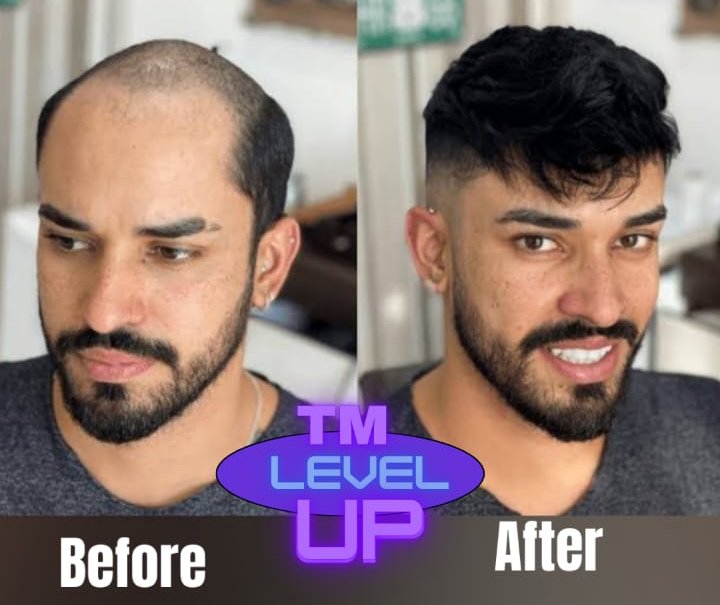 hair Replacement