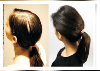 Hair Replacement